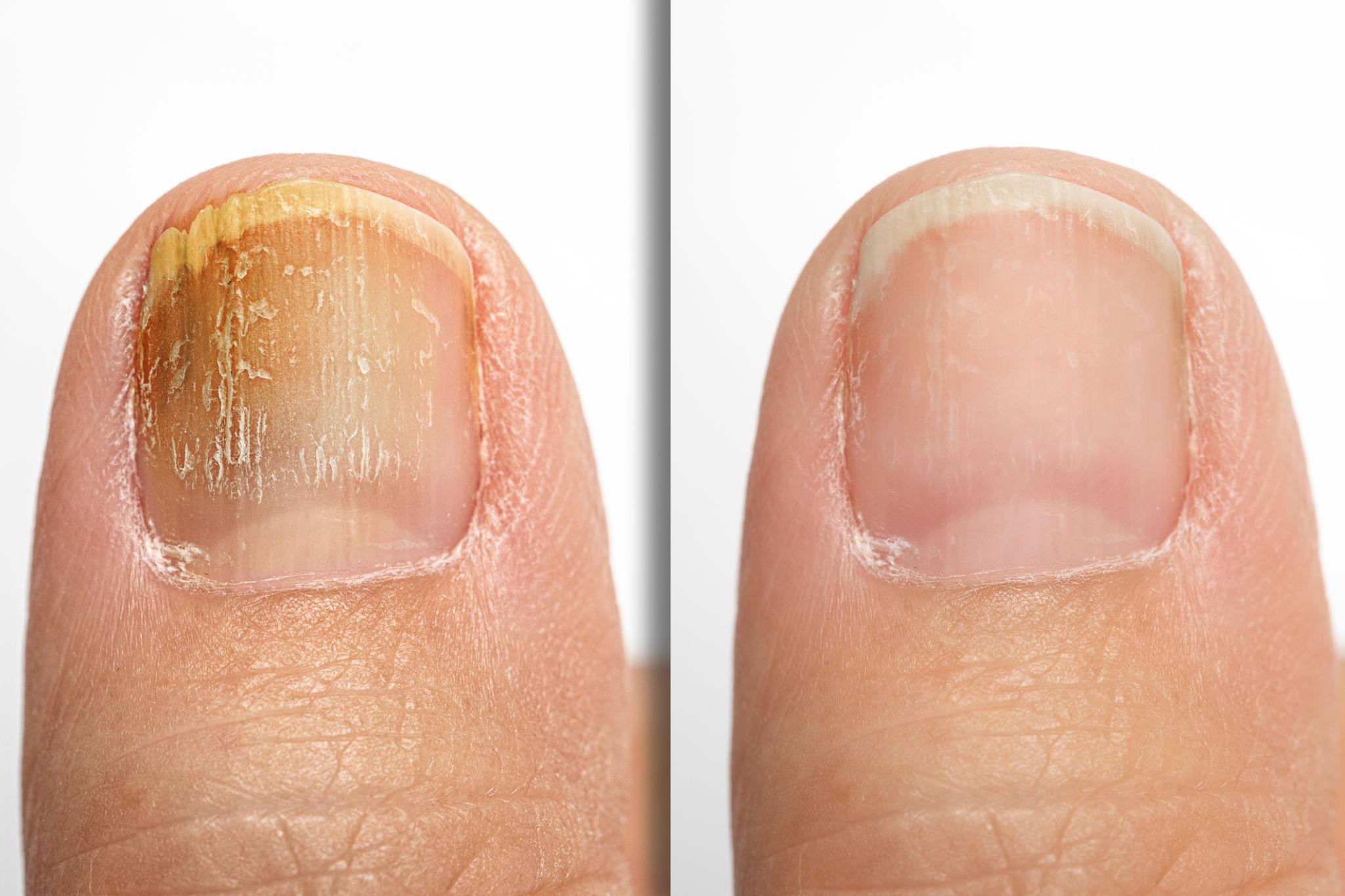 Before and after nail appearance comparison