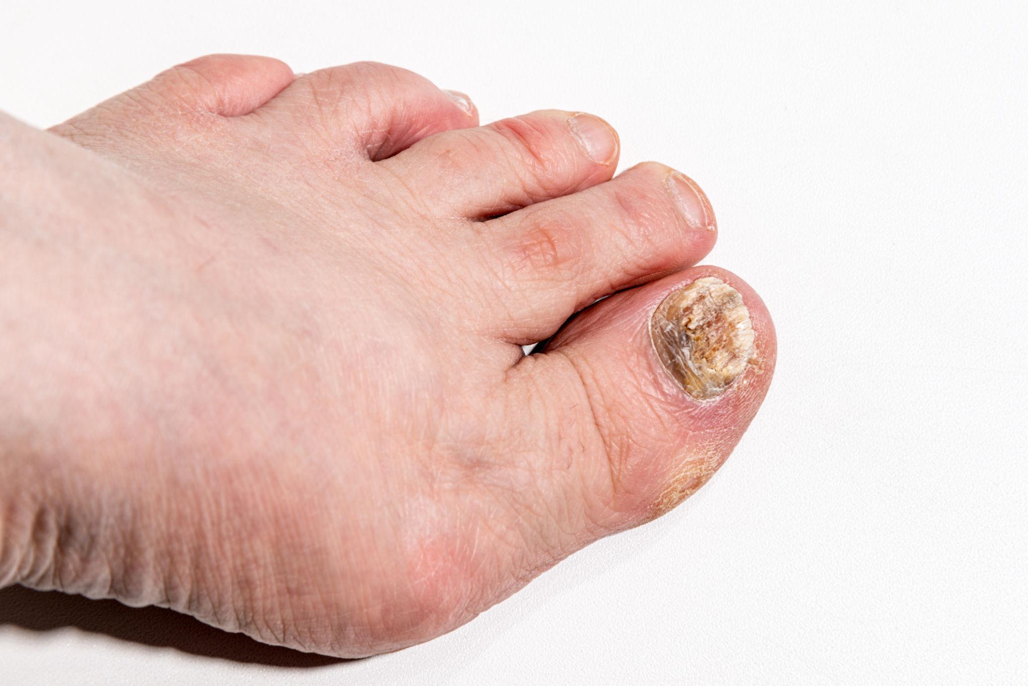 Example of nail fungus appearance